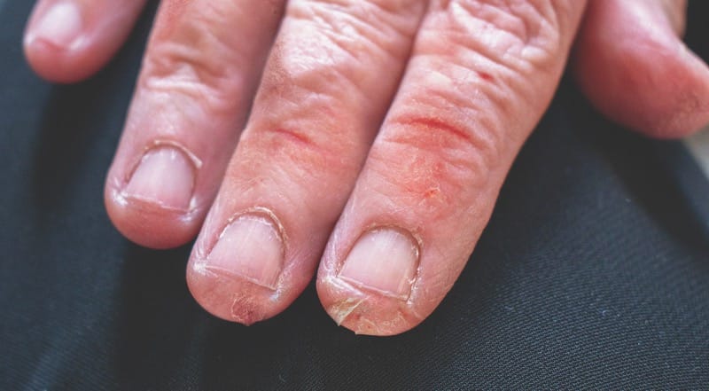  Patient’s fingers before treatment with fludroxycortide tape